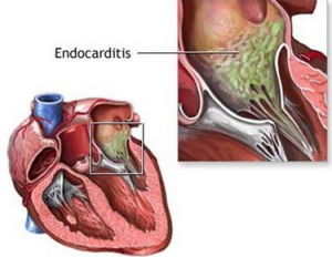 心臟內膜炎