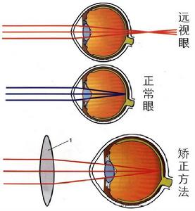 遠視[眼科疾病]