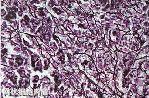 淋巴網狀細胞肉瘤