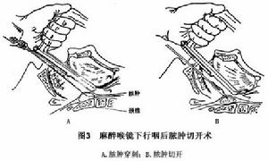 咽後間隙感染