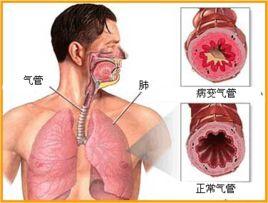 老年支氣管哮喘