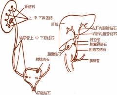 結石病