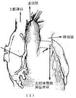 冠狀動脈畸形