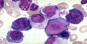 巨幼細胞貧血