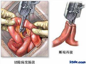 短腸綜合徵