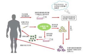 腦膠質瘤生物刀流程圖