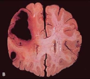 Thrombus