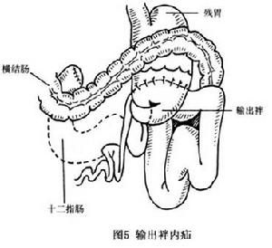 胃切除術後內疝 圖5