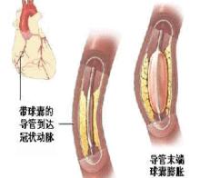 心臟支架手術