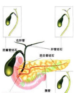 急性重症膽管炎