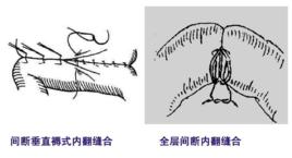 內翻縫合