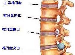 腰椎膨出