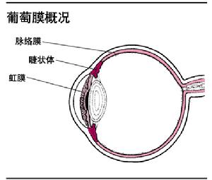 （圖）葡萄膜病