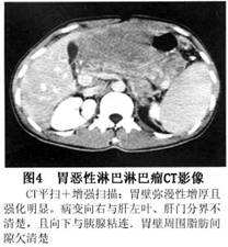 原發性胃淋巴瘤