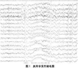 全面性發作