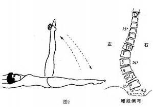 脊柱側彎的體育療法