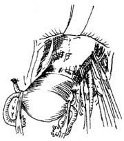 示意圖10:切開硬脊膜