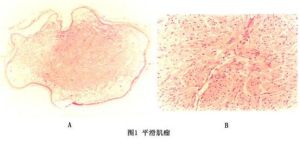 （圖）皮膚平滑肌瘤