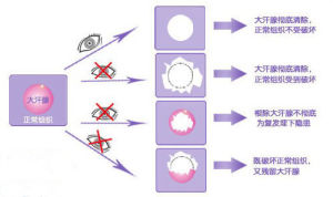 韓式NKJ汗腺消融術治療優勢