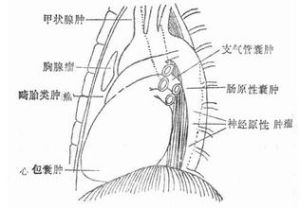 縱隔腫瘤