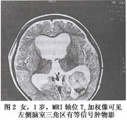 （圖）兒童脈絡叢乳頭狀瘤
