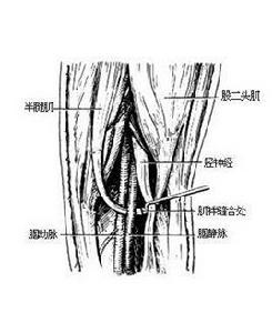 膕動脈破裂