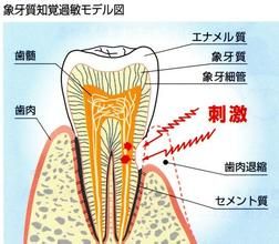 楔狀缺損