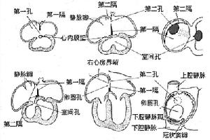 妊娠合併心房間隔缺損