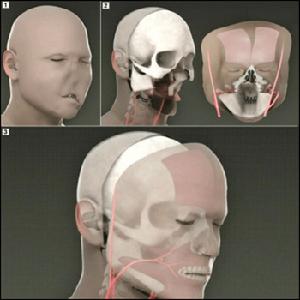 世界首例全面變臉手術步驟圖