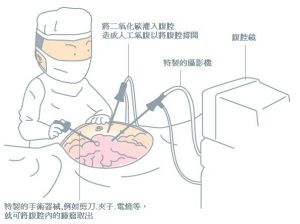 腹腔鏡手術