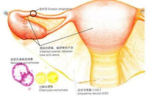 大腸皰疹