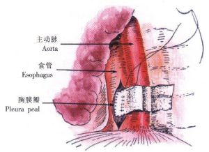 異物性食管穿孔
