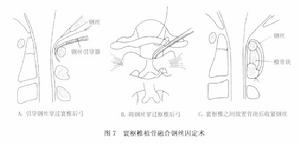 （圖）上頸椎不穩症