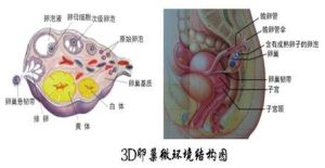 多囊性卵巢囊腫