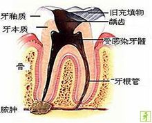 牙髓息肉