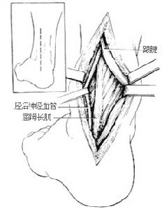 （圖）踝關節骨折