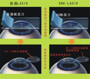 LASIK雷射手術原理