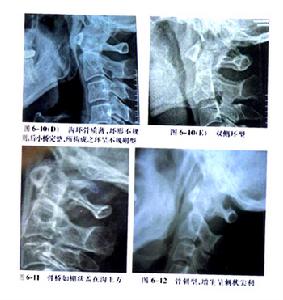 老年頸性眩暈