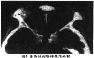 眼眶澱粉樣變性