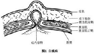 白線疝