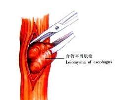 食管平滑肌瘤