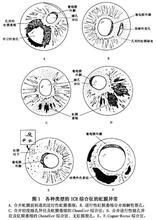 青光眼