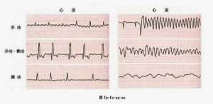 心室撲動和心室顫動