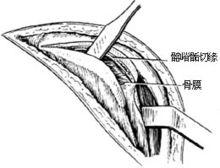 示意圖2:顯露髂骨翼內側面