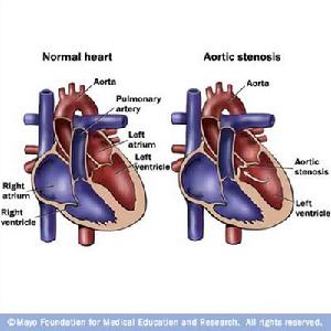 先天性主動脈瓣上狹窄