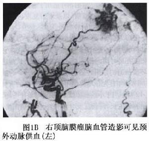 大腦凸面腦膜瘤