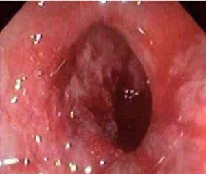 （圖）老年人缺血性結腸炎