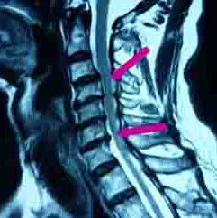 頸椎椎管狹窄
