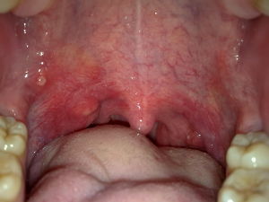 急性咽喉炎