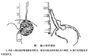 膈下食管憩室